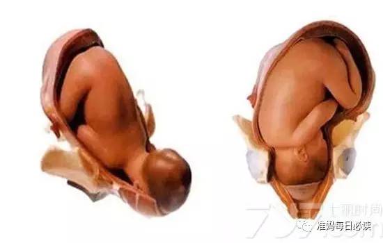 “看星星的宝宝”该怎么通过产道？分娩真是一门大学问！