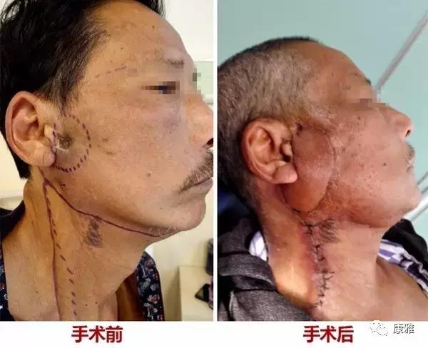 面部有这样黄豆大小的肿物，要当心了！