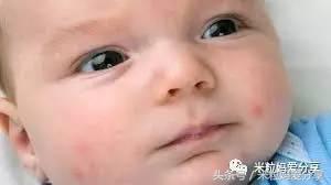 湿性湿疹的症状和治疗方法,湿疹到底是怎么来的呢