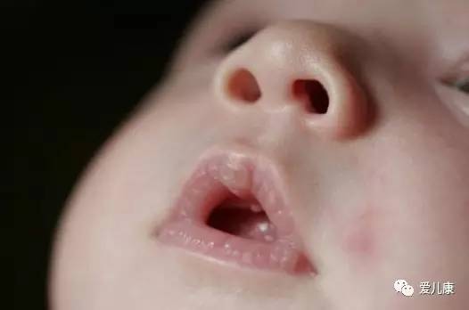 鼻子不通儿科医生,宝宝鼻子不通有什么好方法