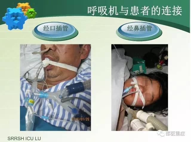 有创机械通气操作,机械通气英文缩写