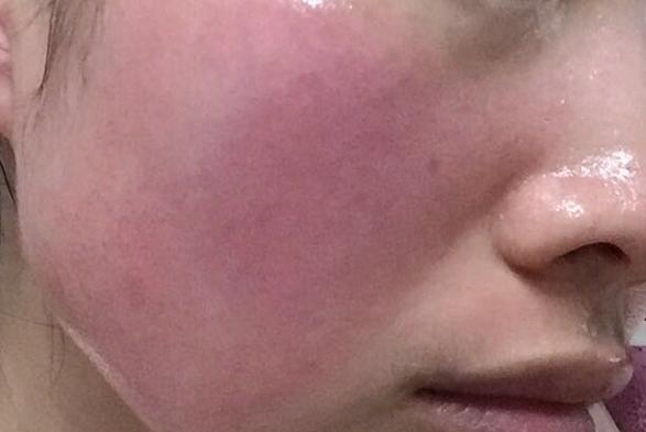 要怎么治疗红血丝最好的方法,红血丝治疗方法帮你快速去红