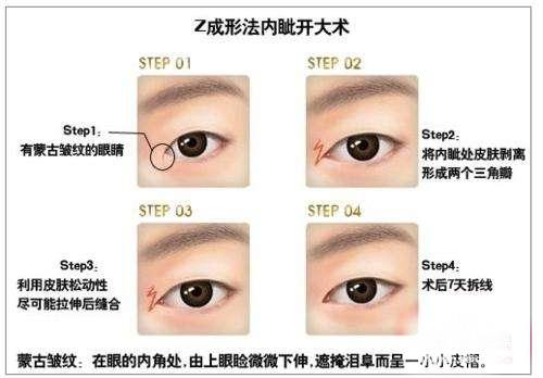 内眼角去哪里开,内眼角怎么开眼角