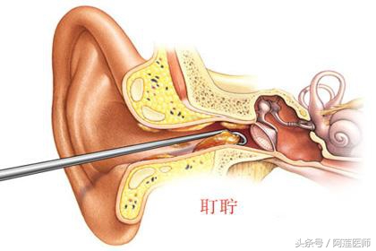 掏耳屎耳朵掏烂疼了好几天,掏耳屎疼是怎么回事