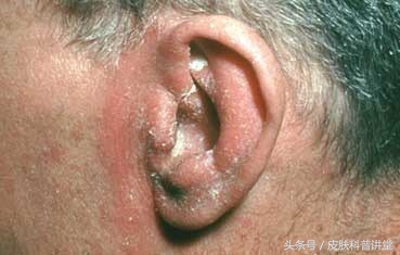 头皮屑多且脂溢性皮炎,头皮屑多头痒脂溢性皮炎