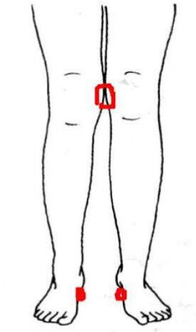 大腿和小腿不在一条线怎么矫正,腿型不好看怎么矫正直腿