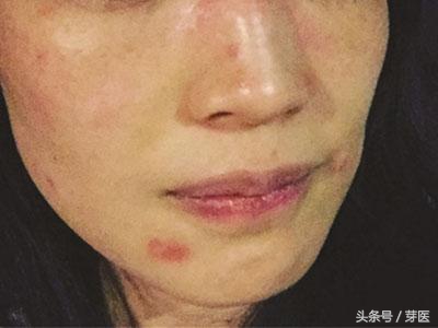 入春皮肤痒,入春脸突然痒怎么回事