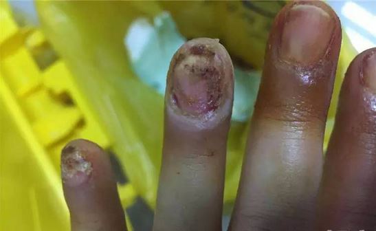 姑娘被拔手指甲,四根手指不敢做美甲