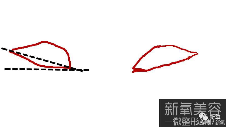 为什么开眼角会变漂亮,为什么开眼角很奇怪