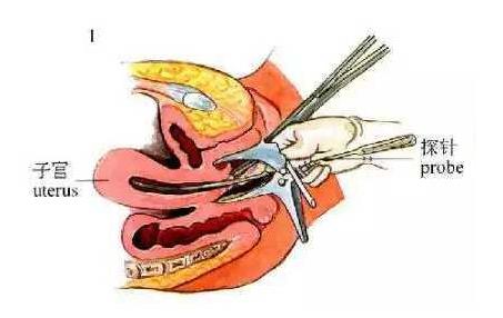 节育环要什么时候取才是最佳时期,节育环取出注意事项