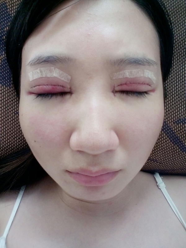 双眼皮全切手术恢复期,全切双眼皮恢复期眼尾分叉正常吗
