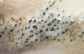 鼻子上的黑头粉刺挤出来有臭味,脸上的黑头粉刺该不该挤出来