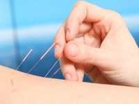 美国医师学会：针灸推荐为治疗急慢性腰痛的唯一一线疗法