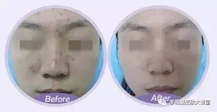 果酸换肤3个月过程,果酸护肤小常识