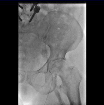 下肢肿胀有效的治疗手段是什么？