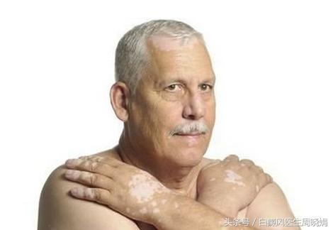 白癜风明星有哪些,白癜风明星