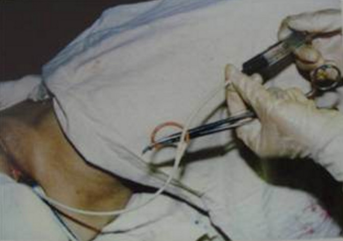 输卵管有多长多粗,输卵管有多细相当于什么