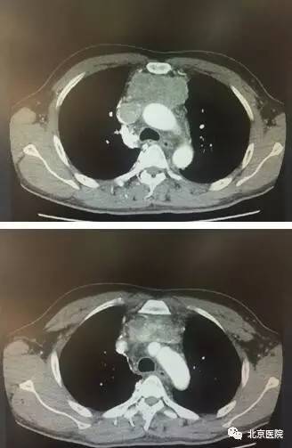 北京胸科医院肺切除术,北京胸科医院肺癌晚期手术