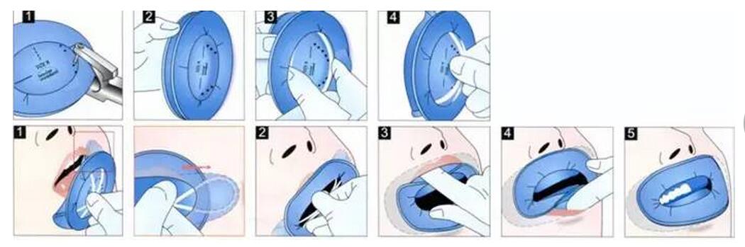 蛀牙没喊痛就不严重?医生却告诉你要做根管治疗!