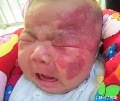 宝妈手部血管瘤,宝宝血管瘤一般多大会消退宝妈们