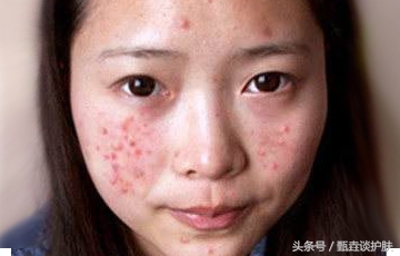 如何祛除痘印男性,如何祛除痘印男生