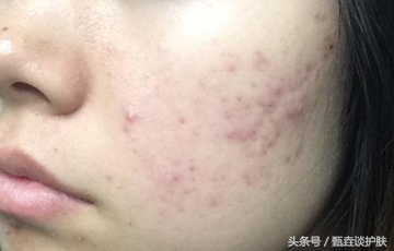 如何去除痘印和黑头,如何祛除痘印学生党