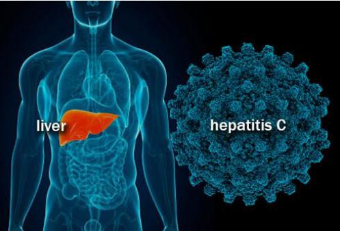 丙肝已经可以治愈你知道吗,丙肝可以治愈吗