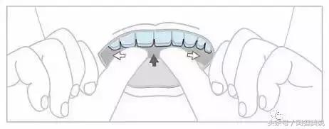 隐适美矫正摘戴攻略,隐适美和正雅隐形矫正哪个好