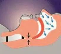 打鼾会引起心梗吗,打鼾会致死吗