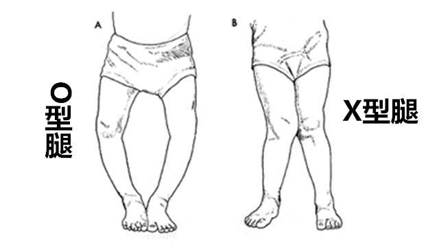 罗圈腿是不是属于o型腿,儿童罗圈腿o型腿怎么矫正