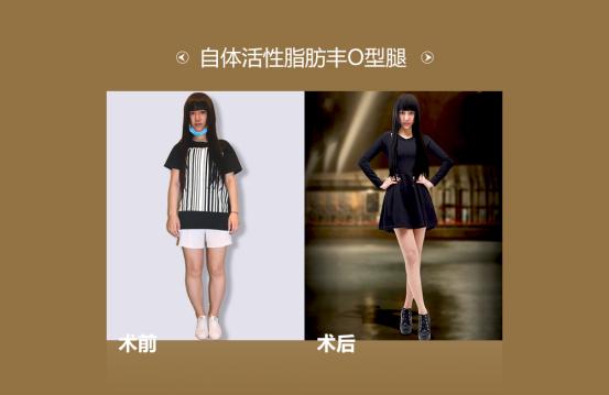 王明利自体脂肪丰臀怎么样,穿什么可以显腿瘦