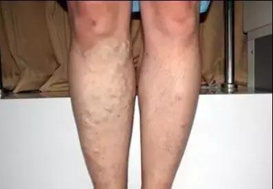 血管衰老怎么补充营养,血管衰老保健案例