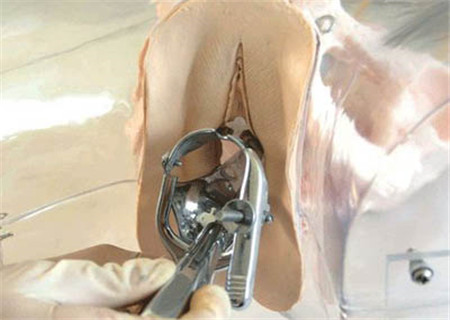 病理性刮宫疼不疼,刮宫后直冒汗什么意思