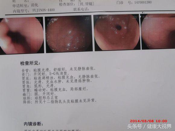 慢性胃炎的折磨,千古第一奇方治胃病