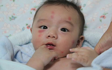 夏天蚊子总叮咬宝宝怎么办,夏天蚊子爱叮孩子怎么办