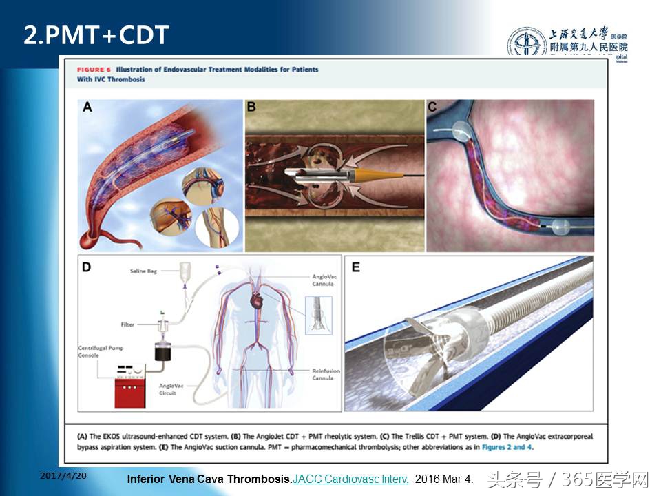 下肢静脉血栓植入滤器后的护理,下肢静脉血栓滤器植入后注意事项