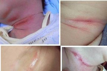 宝宝淹脖子导致破皮抹什么好得快,宝宝淹脖子擦红霉素软膏还是眼膏