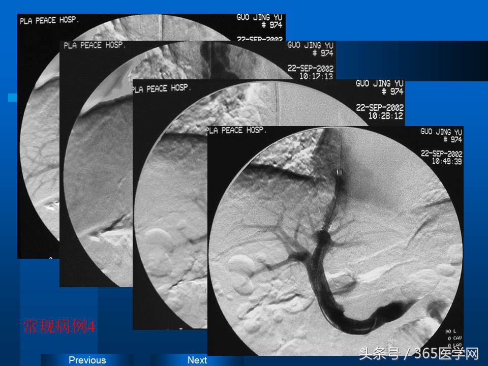 崔进国：消化道出血的介入治疗