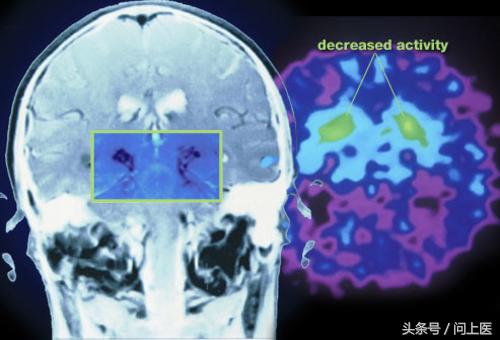 全方面了解帕金森疾病,从小帕金森怎样锻炼