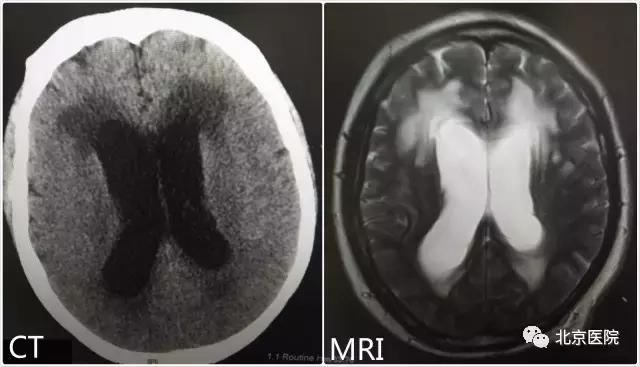 北京儿童医院神经外科脑积水,北京宣武医院神经外科脑积水