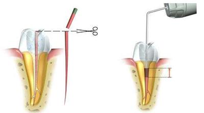 根管治疗过后还需要做牙套吗,根管治疗戴冠能用几年