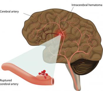 脑出血的症状与治疗方法是什么,脑出血症状清除血块后恢复