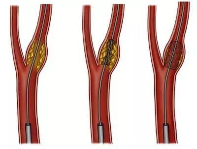 颈动脉斑块会引起脑中风吗,天生右颈动脉狭窄会导致脑中风吗