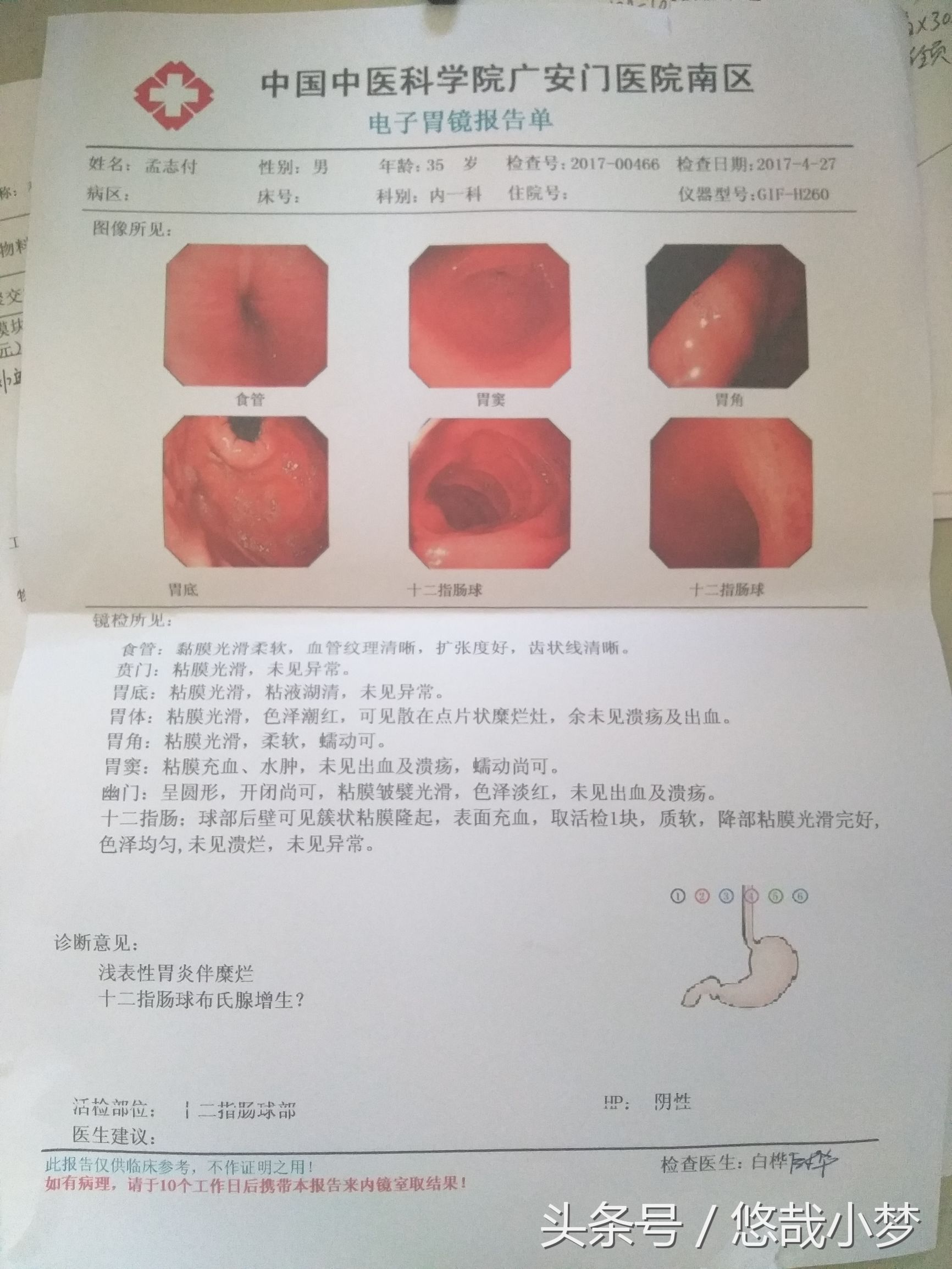 无痛胃镜初体验,无痛胃镜医学科普