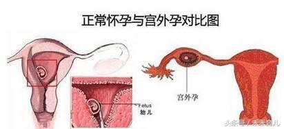 宫外孕早期症状有哪些表现,宫外孕基本知识