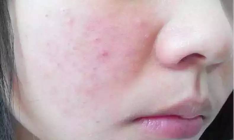 祛痘印简单不花钱小妙招,去痘印最有效的方法值得收藏