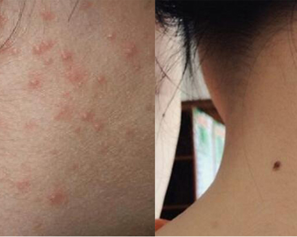 脖子后面长痘痘的原因女生,脖子后面长痘痘怎么办不疼