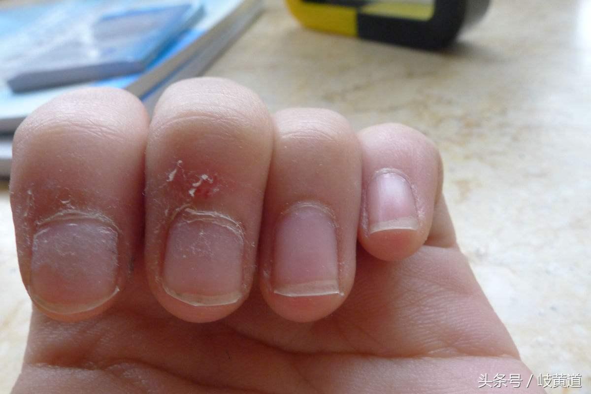 女子手撕倒刺后续,女子手撕倒刺进了医院