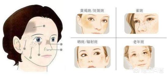 如何快速有效祛斑的方法,如何快速有效祛斑