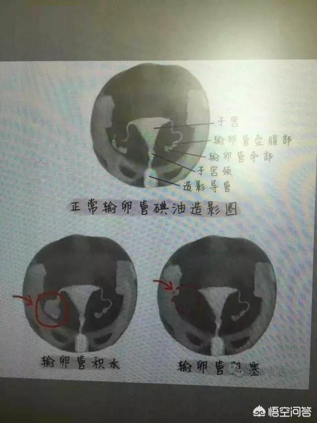 怎么确认输卵管是否通畅,怎么自己检查输卵管是不是通畅